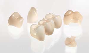 Cerec-ceramics-photo-1